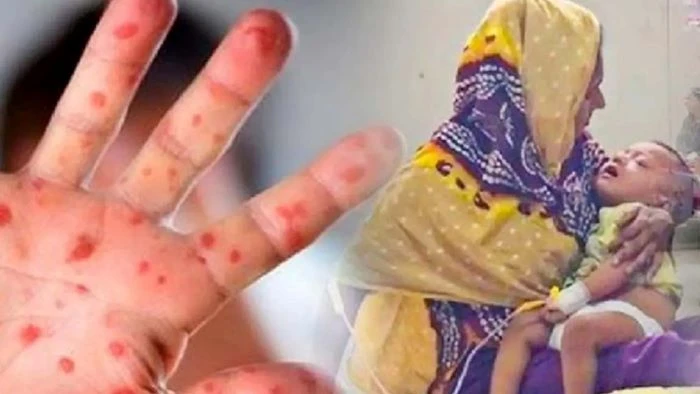 হাম-উপসর্গে আরও ৩ শিশুর মৃত্যু, আক্রান্ত ছাড়ালো ১ হাজার